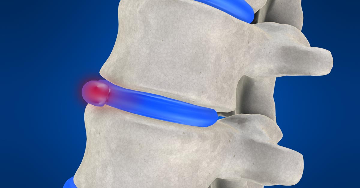 Asheville non-surgical disc herniation treatment